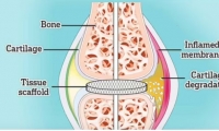 طريقة لإعادة نمو الغضروف لمصابي التهاب المفاصل